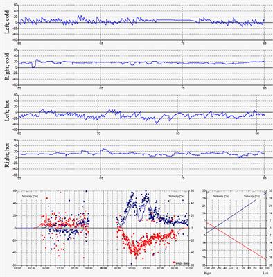 Palinopsia Following Acute Unilateral Partial Vestibular Deafferentation: A Case Report